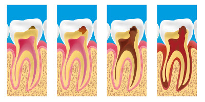 caries dentiste epinay sur seine