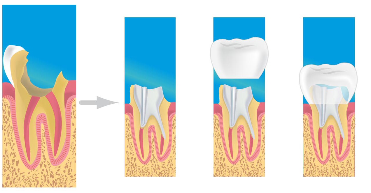 prothese dentaire epinay sur seine